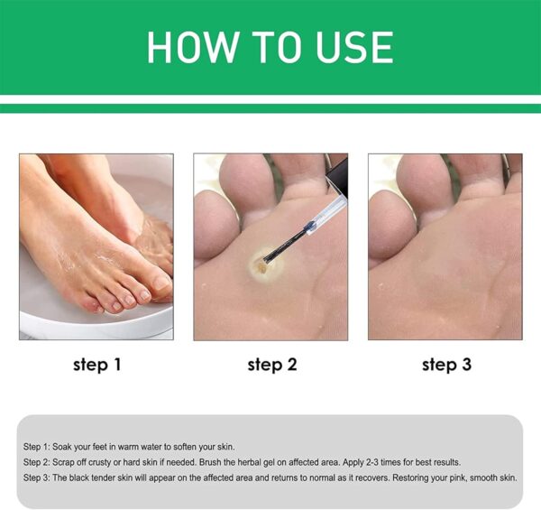 Active Corn Remover Strengthener Gel অ্যাকটিভ কর্ন রিমুভার স্ট্রেংথেনার জেল