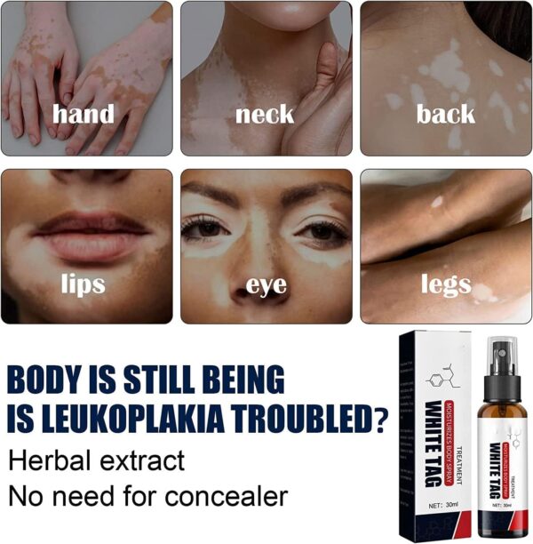 White Tag Cream – Effective Vitiligo Treatment Cream White Tag ক্রিম – ভিটিলিগো চিকিৎসার জন্য কার্যকরী ক্রিম