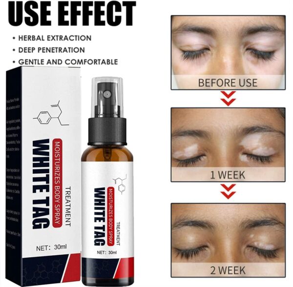 White Tag Cream – Effective Vitiligo Treatment Cream White Tag ক্রিম – ভিটিলিগো চিকিৎসার জন্য কার্যকরী ক্রিম