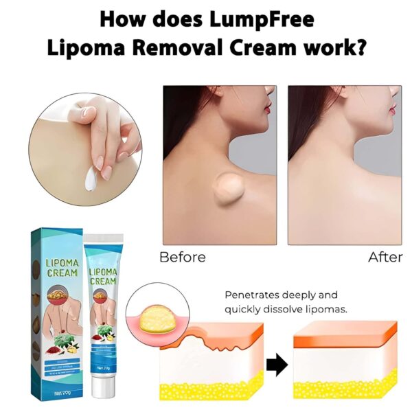 20g Lipoma Removal Cream  ২০ গ্রাম লিপোমা রিমুভাল ক্রিম