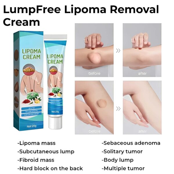 Lipoma Removal Cream3